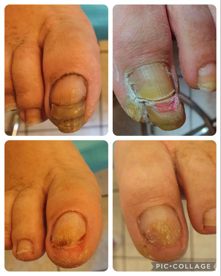 Unghie del piede prima e dopo il trattamento podologico, in totale assenza di dolore.